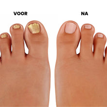 Afbeelding in Gallery-weergave laden, PureNail - Gepatenteerde nagelschimmeltherapie – voor gezonde nagels binnen 4 weken
